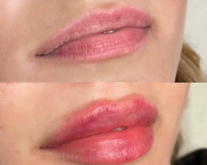  Увеличение губ в киевской клинике Esteva Clinic