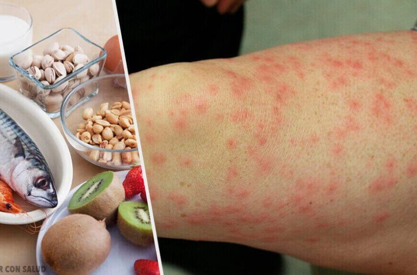  Алергія на продукти: причини, симптоми та методи лікування