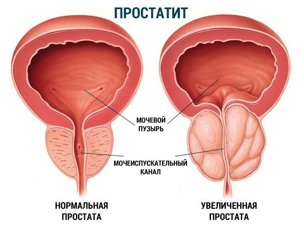  前立腺炎：症状、原因、治療、予防