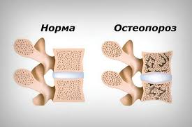  Остеопороз: що це таке, симптоми, лікування та профілактика