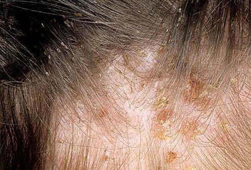  Pédiculose : Causes, Symptômes, Traitement et Prévention